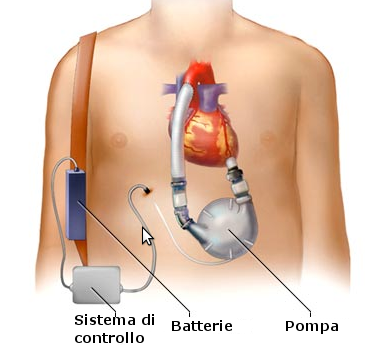 Dispositivi di assistenza ventricolare (VAD).png