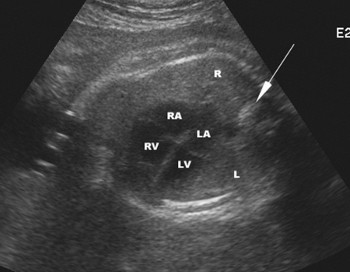 Trasposizione delle grandi arterie.jpg