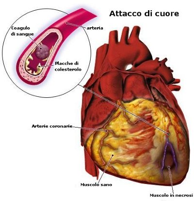 anatomia dell'attacco di cuore2.jpg