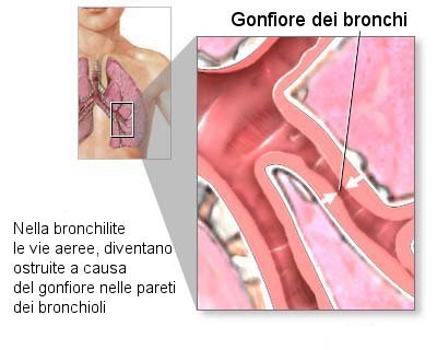 bronchiolite-schema.jpg