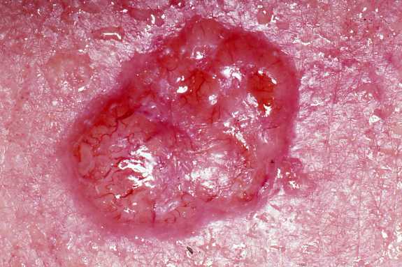carcinoma a cellule basali 21.jpg