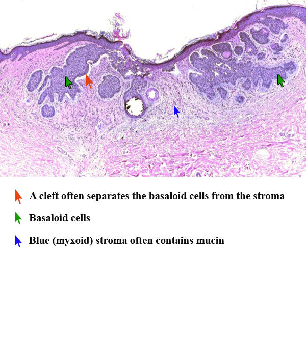 carcinoma a cellule basali1.jpg