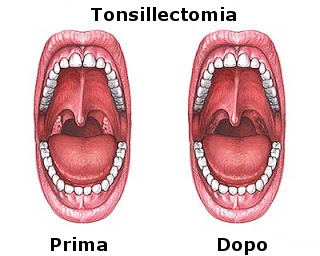 Tonsillectomia