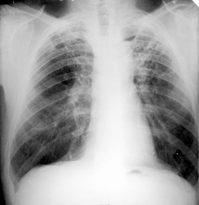 tuberculosi2.jpg