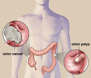 tumore colon.gif