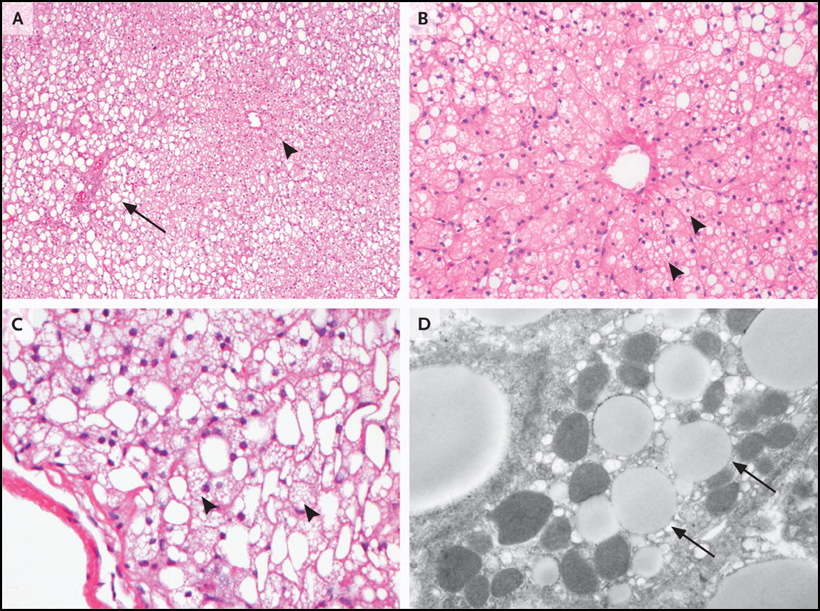 Ingrossamento Del Fegato Sintomi Cause Diagnosi Cure E