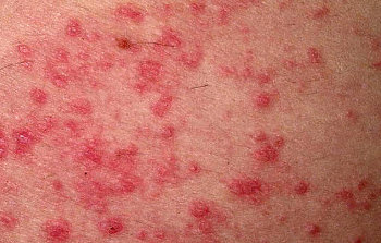 Dermatite Atopica Eczema Cure Cause E Sintomi Informazioni Mediche