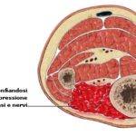 rp_sindrome-compartimentale-da-sforzo.jpg