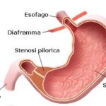 rp_Stenosi-pilorica.jpg